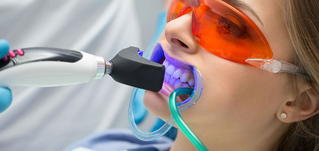 In-Office Whitening