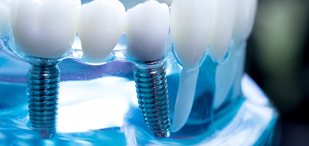 Dental Implants