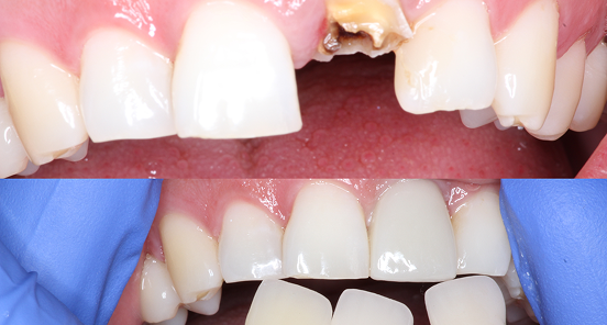 Implant Case Study 1