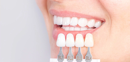 Porcelain crowns or overlays for strength and durability